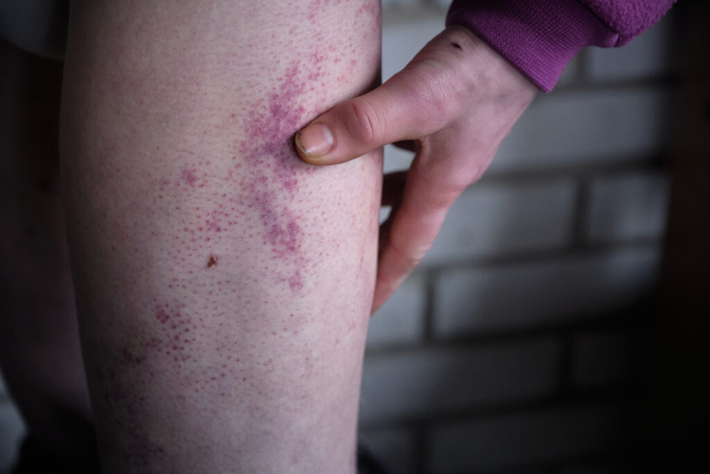 Donbas Frontliner / Sergey shows bruises resulting from beating by Russian soldiers